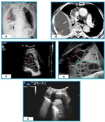 Chest Imaging in the Diagnosis and Management of Pulmonary Tuberculosis: The Complementary Role of Thoraci Ultrasound